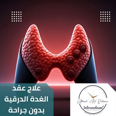 علاج عقد الغدة الدرقية بدون جراحة